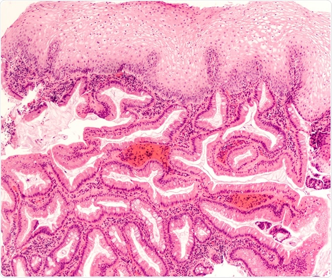 Intestinal (Barrett's) metaplasia of the esophagus is a response to injury from acid reflux (heartburn). It is associated with dysplasia and adenocarcinoma. Endoscopic biopsy photomicrograph. Image Credit: David Litman / Shutterstock